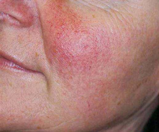 Hydrafacial
